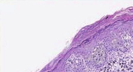 Invasive melanoma, superficial spreading melanoma MPATH-Dx class V Invasive melanoma, heavily pigmented melanoma Total 3 2 4 2 5 5 4 36 Fig Diagnostic terms given to example case by 36 pathologists
