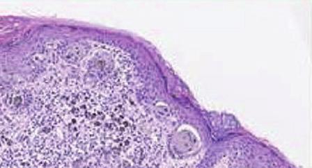 biopsy lesions of the same case at phase and phase 2 at least eight months apart* Phase diagnosis 6 Phase 2 diagnosis (No of paired interpretations) Class I Class II Class III Class IV Class V Total