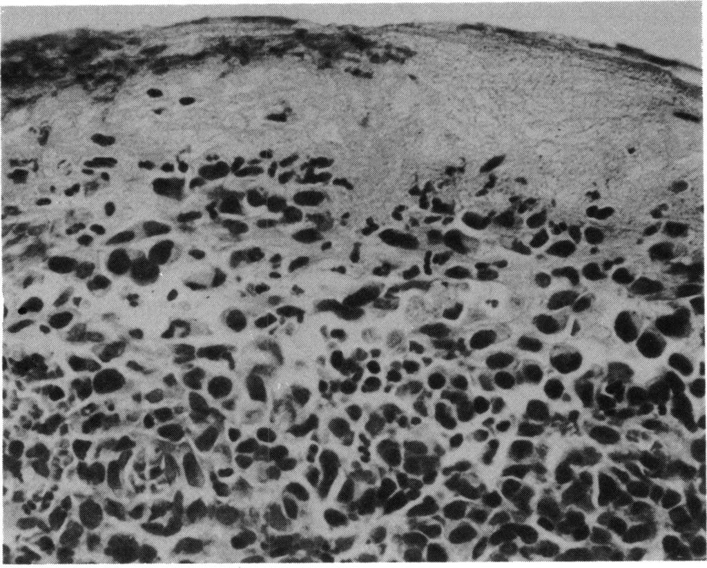 184 Fig. 9 Case 13. Nodular malignant melanoma. There is necrosis ofthe overlying epidermis, and the pleomorphic tumour cells have large, hyperchromatic nuclei. (Haematoxylin and eosin, x 400). 9.4 yr, with all of the surviving cases being followed up for 5 yr or more.