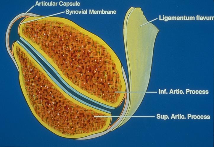 The Facet Joint Joint capsule encloses joint articular cartilage & synovial membrane Synovial membrane