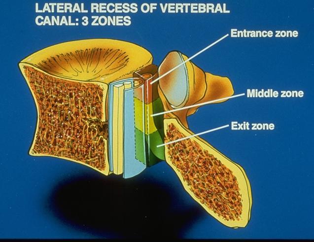 Zones of Nerve Root Entrapment In The Lumbar Spine The entrance zone of the root beneath the facet is called the subarticular recess, and is bordered by the superior facet.