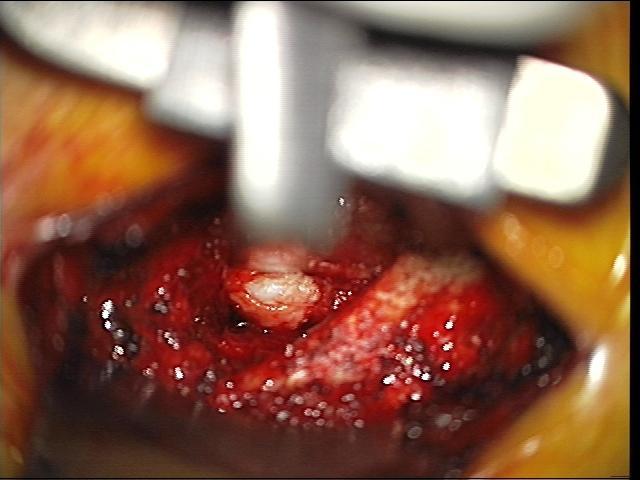 Lumbar Microdiscectomy Use of operating microscope to allow minimal incision