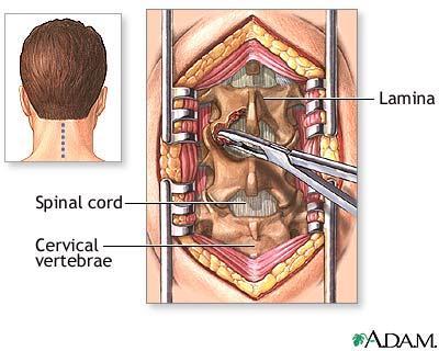 Cervical Decompressive Typically done for stenosis with myeloradiculopathy Usually for stenosis at more than two levels Posterior