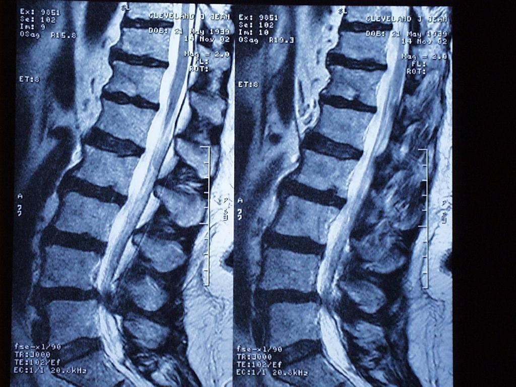 Lumbar Decompression with Surgical choice for stenosis with unstable spondylolisthesis