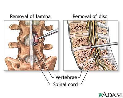 Posterior & Transforaminal Interbody Avoids need for an additional surgical exposure of the spine, whether