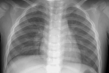 Pulmonary tuberculosis classically divided: Primary TB lymphadenopathy and parenchymal disease