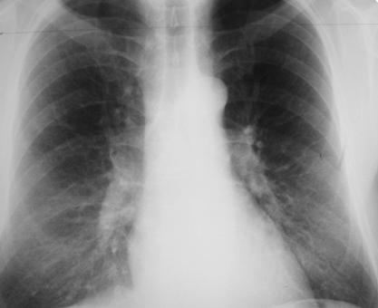 Causes of a missed diagnosis Chest plain
