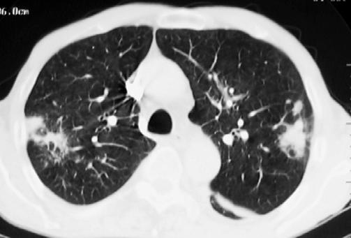 Causes of a missed diagnosis TB, parenchymal disease right lobe Squamous cell carcinoma left lobe any image of lung