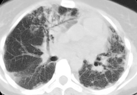 or segmental airspace consolidation may mimic lung