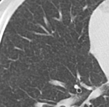 Miliary TB widespread hematogenous may be the only pulmonary