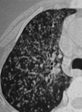 throughout both lungs thickening of interlobular septa and fine