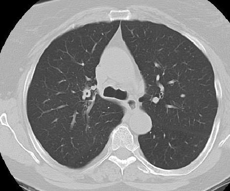 Airway Tuberculosis Chest CT bronchial deformity the most common cause of
