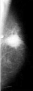 TB of mammary glands Mammography spiculated mass