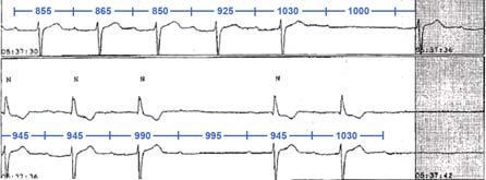 block or third degree AV block pacemaker 1. Atropine 1 2.