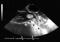 I decide to go with Elective Cardioversion I decide to go with Elective Cardioversion Prior to cardioversion: 1, 2 Can exclude preexisitng thrombus by TEE Can anticoagulate (therapeutic/ for at least