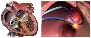 Atrial fibrillation ablation Elective, generally takes time to