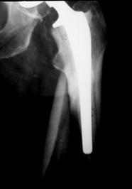 PERIPROSTHETIC FRACTURES FOLLOWING TOTAL HIP ARTHOPLASTY Jon