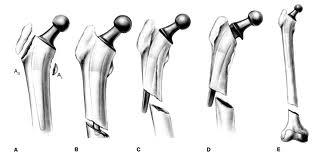 Garbuz DS, Masri BA, Duncan CP: Fractures of the femur following total joint arthroplasty, in Steinberg
