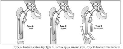 Bethea System Clin Orthop.