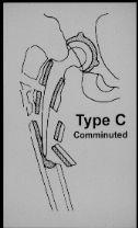 Type C Proximal to tip Comminution around stem Radiographic Evaluation of The Periprosthetic