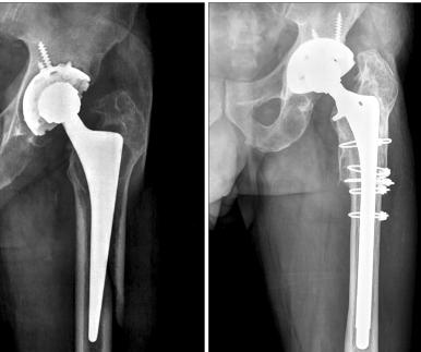 Revision for Periprosthetic Hip Fractures Remove loose cement &/or lytic debris Revise to Revision