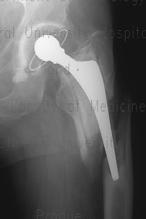 proximal Surgical Technique for Periprosthetic Hip Fractures Avoid circumferential stripping
