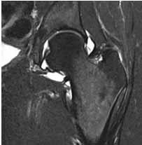 cyst Labral tears Most tears anterior-superior labrum Posterior and
