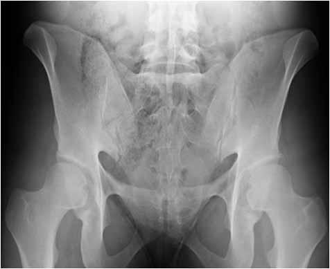20 y.o with left SI joint pain Occult traumatic fractures Occult traumatic fractures MR strongly indicated for negative plain film Recommend exam by ortho Include sacrum in