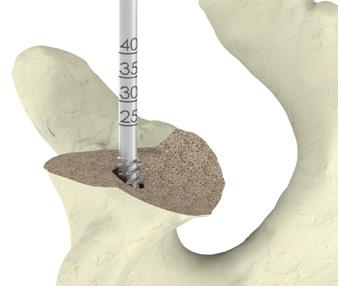 To ensure an accurate evaluation of the final screw length, make sure the flat end of the depth gauge is contacting the paleo surface of the glenoid.