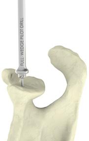 Full Wedge Augment Sizing the Glenoid and Pin Placement Using a the same cannulated approach as described in steps 1-4 above, a single use 2.