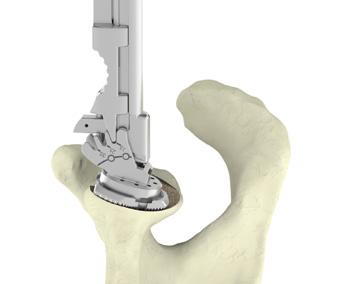 Place the neo reamer assembly over the guide pin and slide the assembly down to the face of the glenoid.