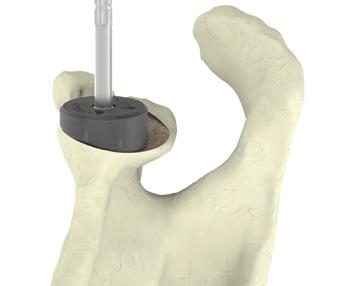 (Figure 23) Note: It is imperative to maintain alignment with the guide pin and rotational alignment to the glenoid while neo reaming.