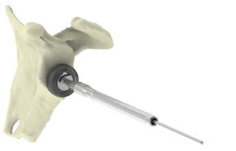 Surgical Steps AEQUALIS PERFORM+ REVERSED Surgical Steps AEQUALIS PERFORM+ REVERSED instrumentation allows for use of different surgical techniques to better suit the clinical situation and surgeon