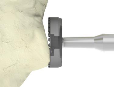 While referencing the face of the glenoid and appropriately seating the assembled pin guide on the inferior edge of the glenoid to reduce the risk of impingement, drill the 2.