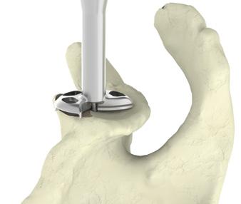 Resurfacing the Glenoid To obtain complete seating and secure fixation of the glenoid baseplate, it is important to create a flat glenoid surface using the cannulated baseplate reamer of the same