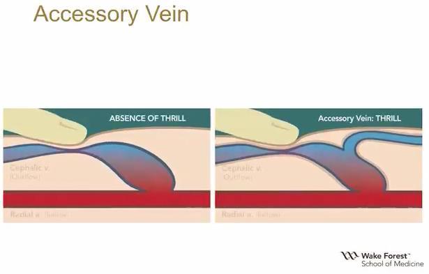 Checking for Accessory Veins Atlas of