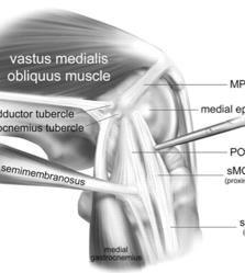 Posteromedial corner Medial collateral ligament Superficial and deep layers Meniscotibial and meniscofemoral ligaments Posterior Oblique