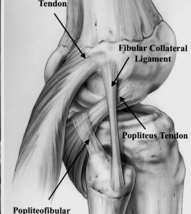 Posterolateral Corner: Static stabilizers Fibular collateral ligament Popliteofibular ligament Posterolateral capsule Popliteus serves as dynamic and static stabilizer