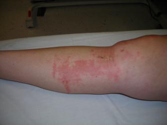 Inspection Skin - Acute Abrasions Lacerations Contusions Infection Limb