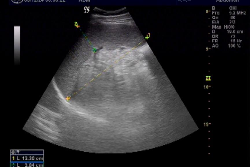 Abdominal Ultrasound the right lobe of the liver diameter of 148mm, the liver volume becomes larger.