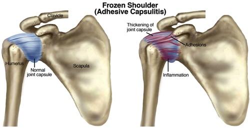 Frozen Shoulder With frozen shoulder the capsule thicknes and contracts (tightens). This may be due to inflammation and formation of scar tissue in the joint.