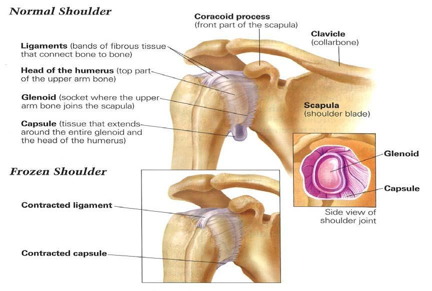 Treatment helps speed up the healing, so you can hopefully regain full range of motion sooner and reduce pain. Stages of Frozen Shoulder Frozen shoulder typically occurs in stages.