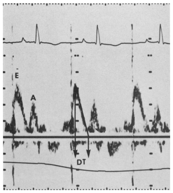 JACC Vol. 14, No. 7 December 1989: 1712-7 OH ET AL. 1713 Table 1. Clinical Characteristics of 11 Study Patients* Blood Pressure AR on Patient Sex/Age (mm LVEF Aorto- No.