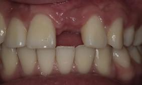 In addition to the color, the soft tissue also plays an important role in the esthetic outcome.