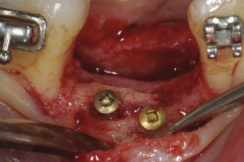 The screws used were always long enough to traverse the residual alveolar process and keep the block firmly attached (Bahat & Fontanessi 2001c).