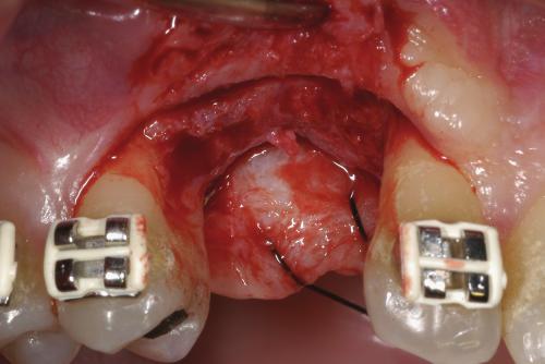 Roccuzzo et al. Bone augmentation with or without titanium mesh Fig. 12. Abutment connection 12 weeks after implant placement (test site). desired position. This is in accordance with von Arx et al.