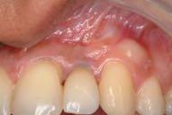periodontitis (Porphyromonas gingivalis, Treponema