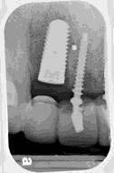 Cement related periimplantitis Peri-implant bone loss in cement- and screwretained prostheses No