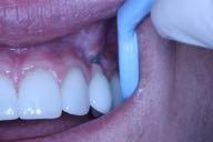 compromised patients in supportive periodontal therapy Increased implantitis and implant loss in
