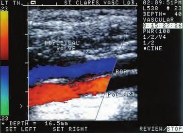 Color scale: Black No flow; Blue/green toward the heart; Red/yellow away from the heart 5 How does normal inflation prevent DVT?